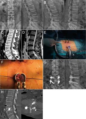 Comparison of Postoperative Outcomes Between Percutaneous Endoscopic Lumbar Interbody Fusion and Minimally Invasive Transforaminal Lumbar Interbody Fusion for Lumbar Spinal Stenosis